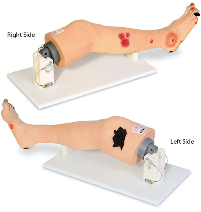 “Vinnie” Venous Insufficiency Leg