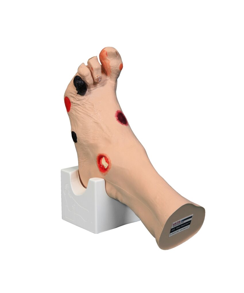 Wilma' Wound Foot™