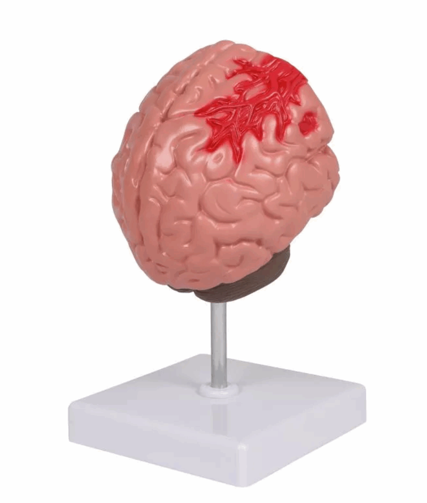 Modelo de Patologias do Cérebro