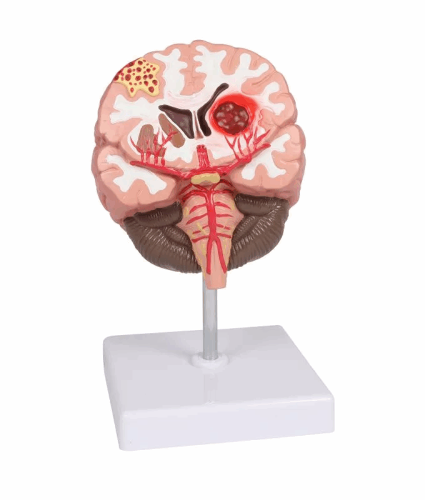 Alternative view of Modelo de Patologias do Cérebro