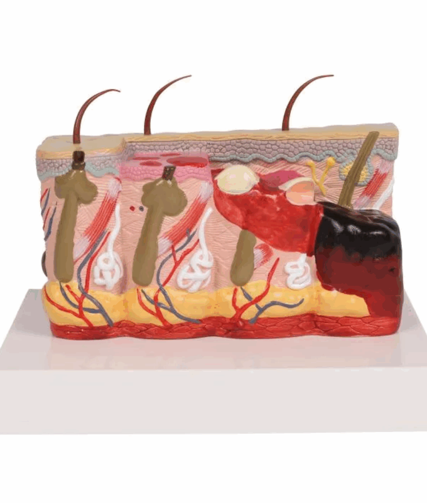 Modelo de Pele Patológica com Queimaduras