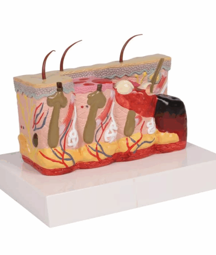 Alternative view of Modelo de Pele Patológica com Queimaduras