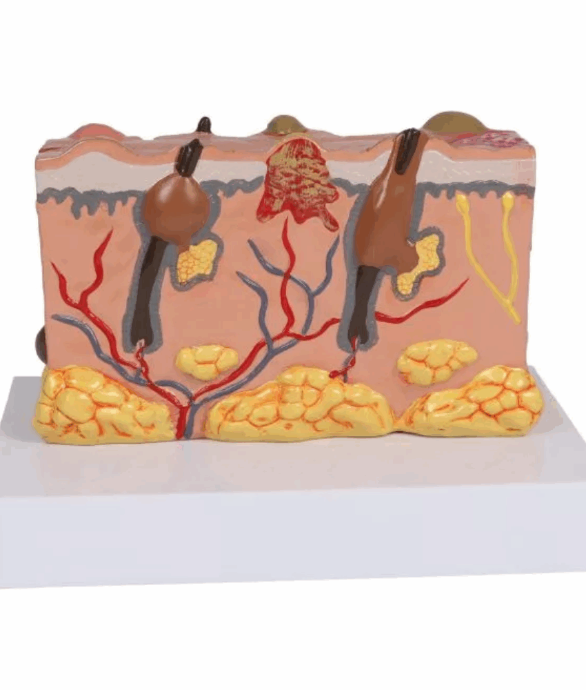 Modelo de Pele Patológica – 30× Tamanho Natural