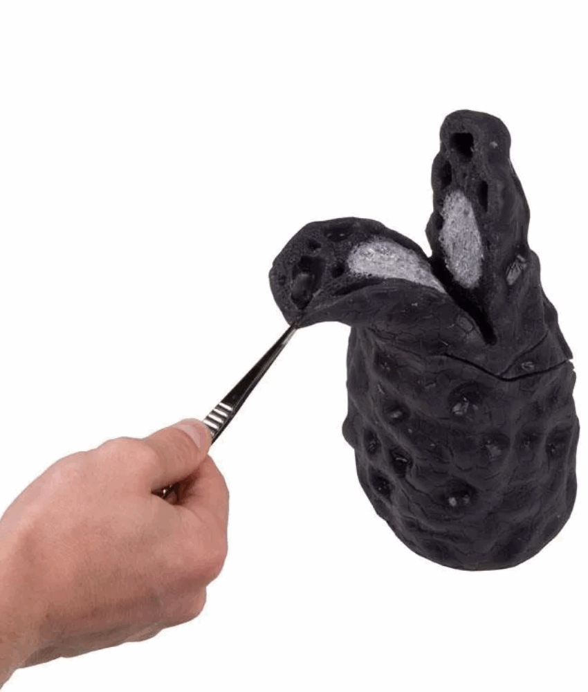 Modelo Anatômico de Pulmão com Câncer