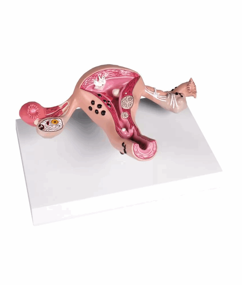 Modelo de Útero com Doenças