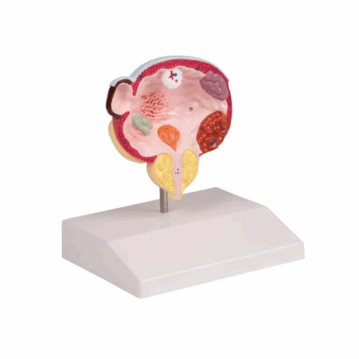 Modelo de Doenças da Bexiga e da Próstata