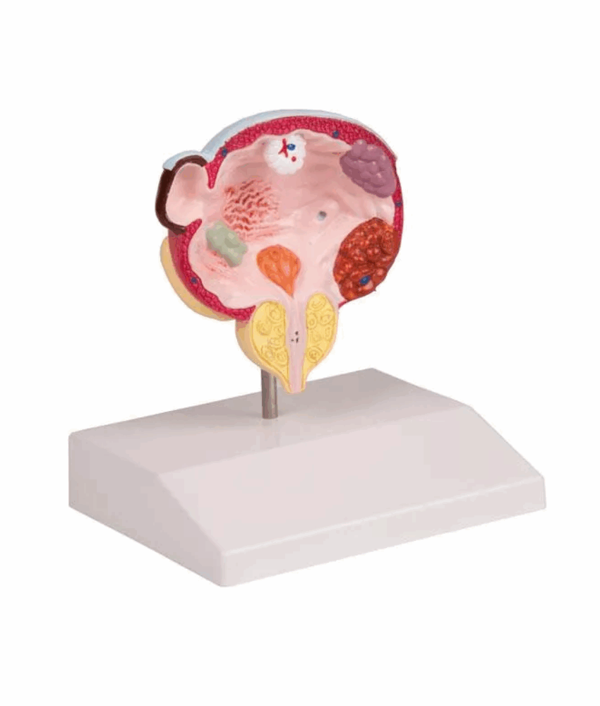 Modelo de Doenças da Bexiga e da Próstata