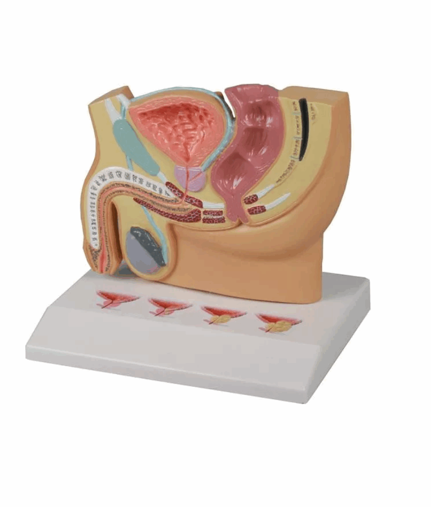 Modelo de Pelve Masculina com Hiperplasia Prostática Benigna