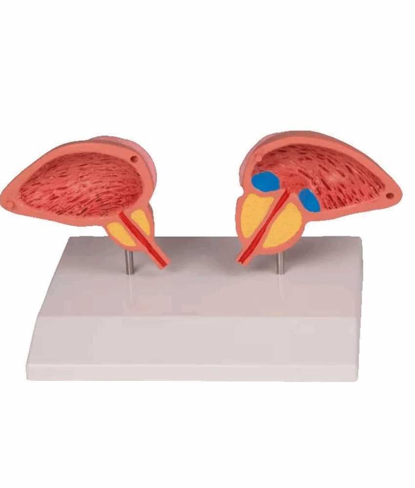 Modelo de Próstata – 2 Partes